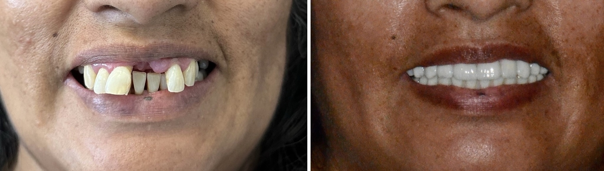 All-on-4 Dental Implants Before and After Results