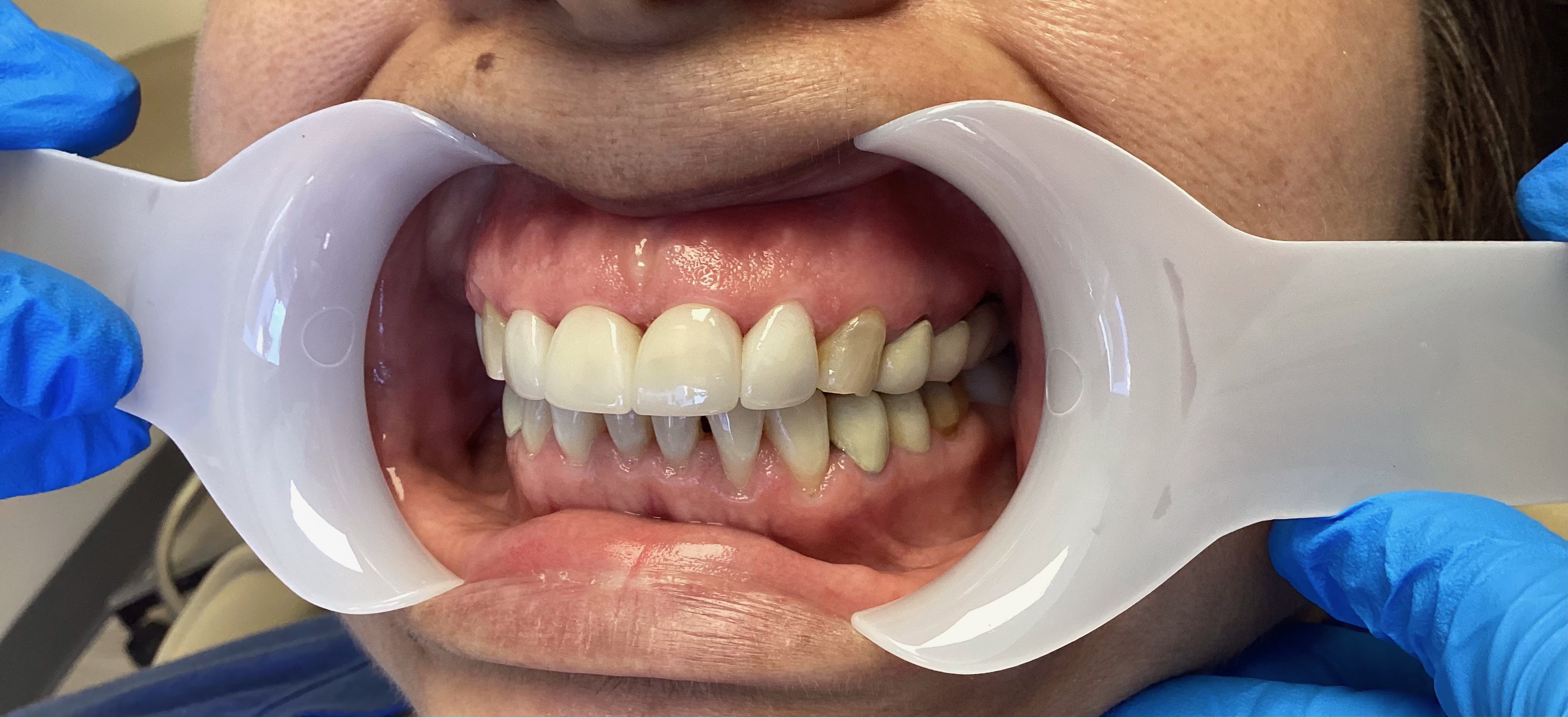 After - Cosmetic Dentistry