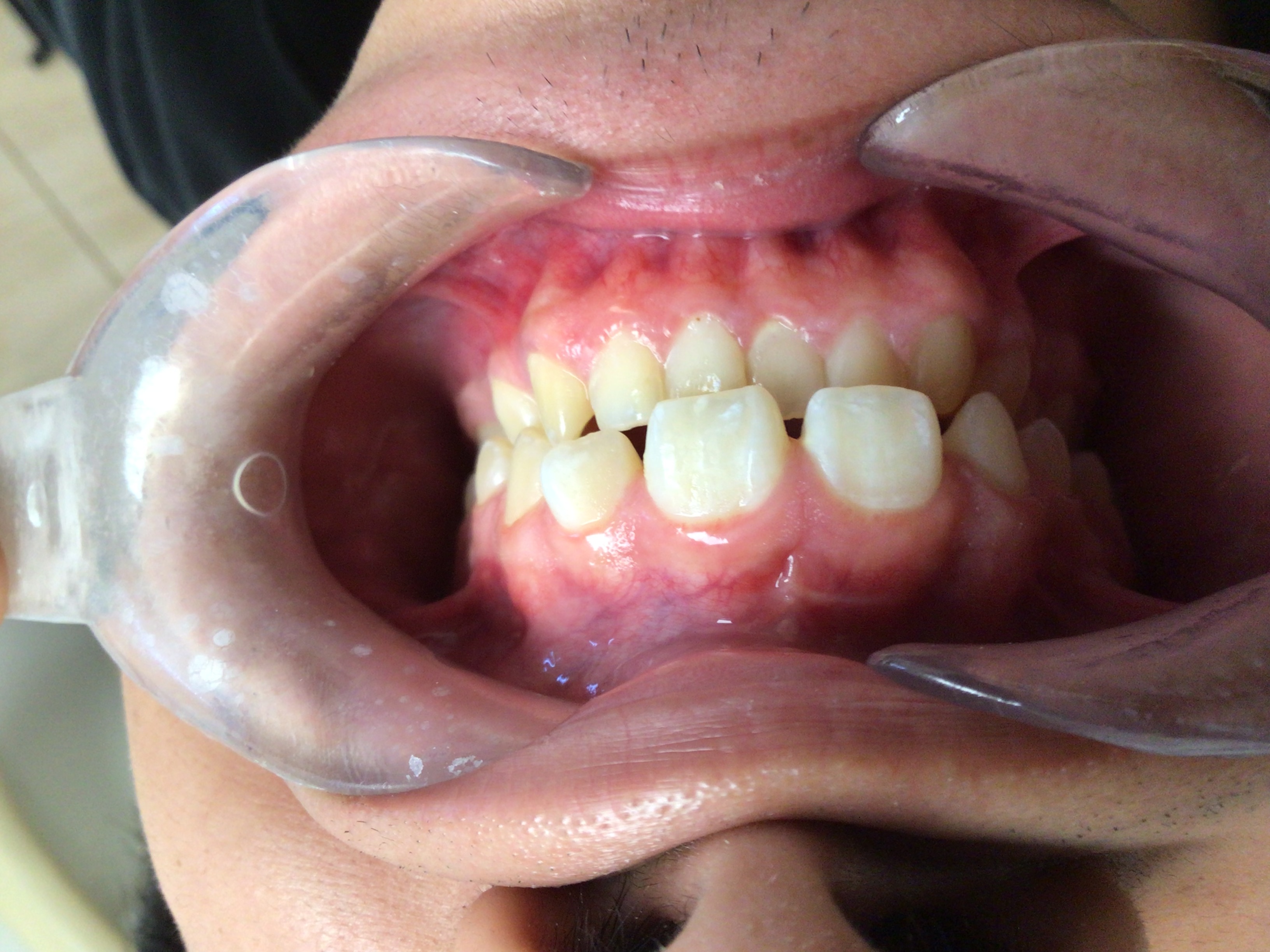 Before - Cosmetic Dentistry